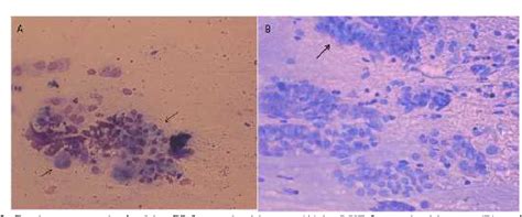 Figure 2 From ASSESSMENT OF THREE DIFFERENT ENDOMETRIAL CYTOLOGICAL