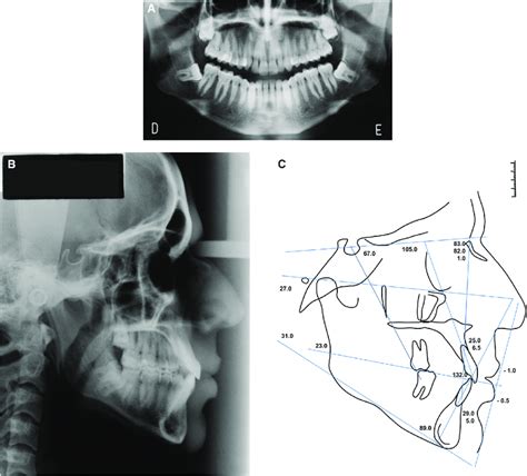 A Pretreatment Panoramic Radiograph B Pretreatment Lateral