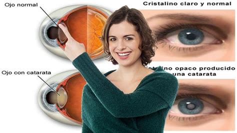 Pin On Como Eliminar La Catarata De Los Ojos Medicina Natural Para Las