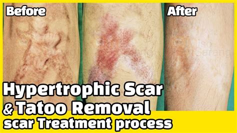 Scar Clinic In Korea Hypertrophic Scar Treatment Process Hypertrophic