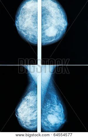 Lumpectomy Images Illustrations Vectors Free Bigstock