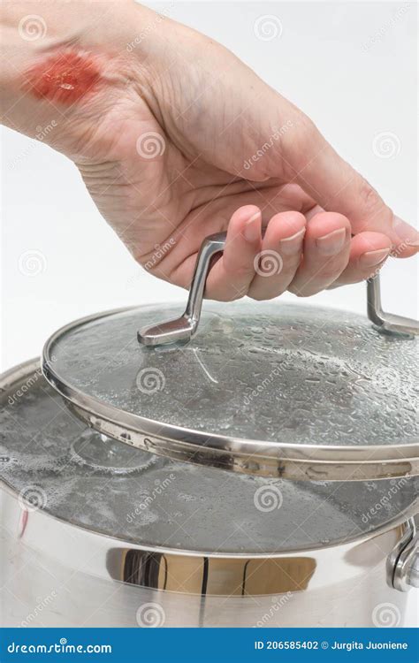 Womanâ€™s Hand With Burns By Hot Steam Holds Lid Of Pot With Boiling