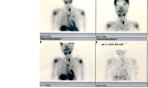 Tc M Sestamibi Scan Of The Neck Showing Hyperactive Parathyroid Nodule