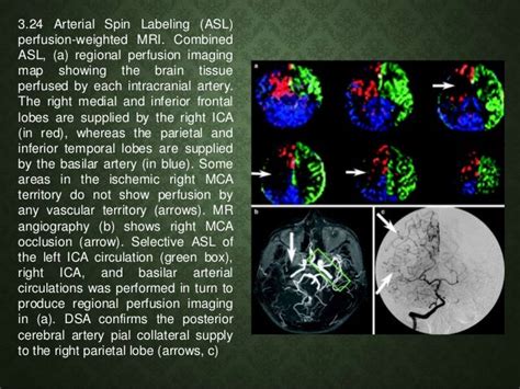 Measurement of Cerebral Blood Flow