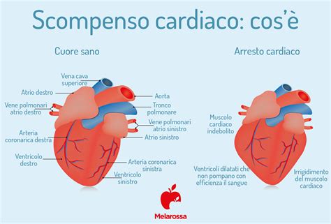 Scompenso Cardiaco Cos Tipologie Sintomi Cause Diagnosi E Terapia