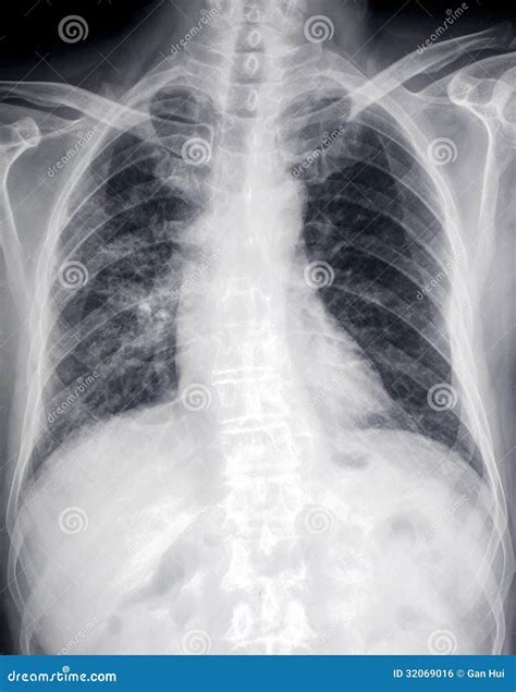 Lung Disease：front X-ray Image Of Heart And Ches Royalty Free Stock ...