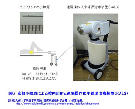 Ri小線源によるがん治療 08 02 02 04 Atomica