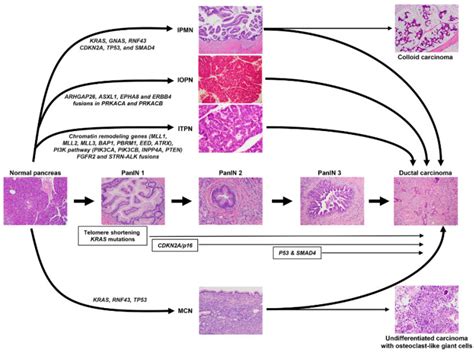 Pancreatic Ductal Adenocarcinoma: Molecular Pathology and Predictive ... 