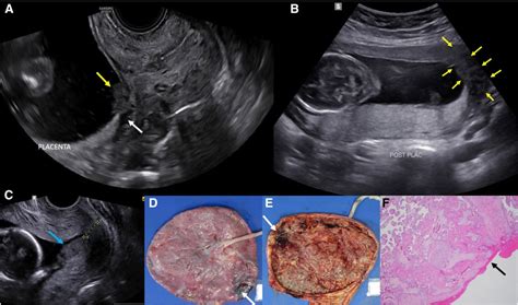 Placental Abruption Ultrasound Diagnosis