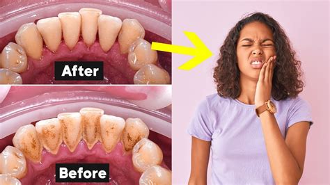 Deep Teeth Cleaning Recovery Tips How To Heal Fast Youtube