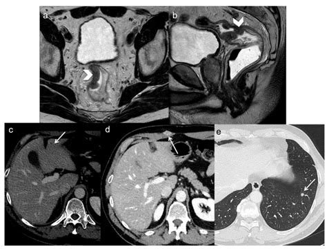 Colon Cancer Mri