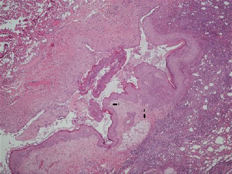 Dermoid Cyst Lined By Keratinized Stratified Squamous Epithelium Arrow