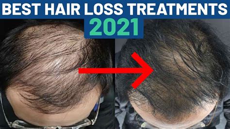 Best Hair Loss Treatments Ranked Fin Min Prp Youtube