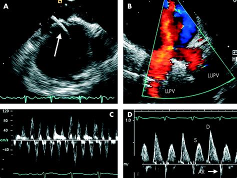 The Role Of Echocardiography In Atrial Fibrillation And Cardioversion Heart