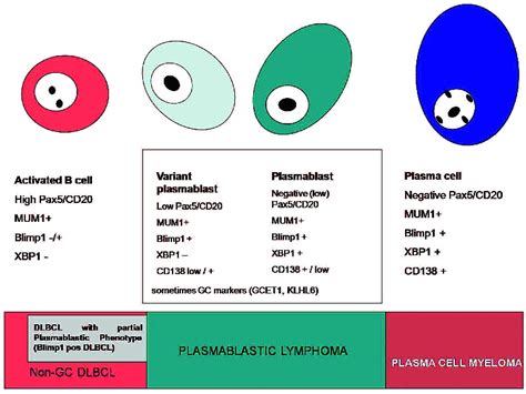 Aggressive Large B Cell Lymphoma With Plasma Cell Differentiation