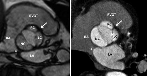 Left Ventricular Outflow Tract Radiology Key