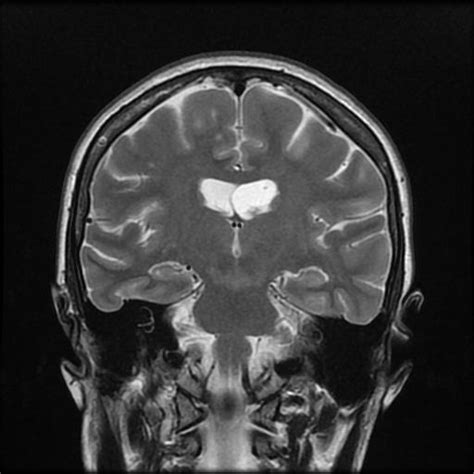 Choroid Plexus Xanthogranulomas Image Radiopaedia Org