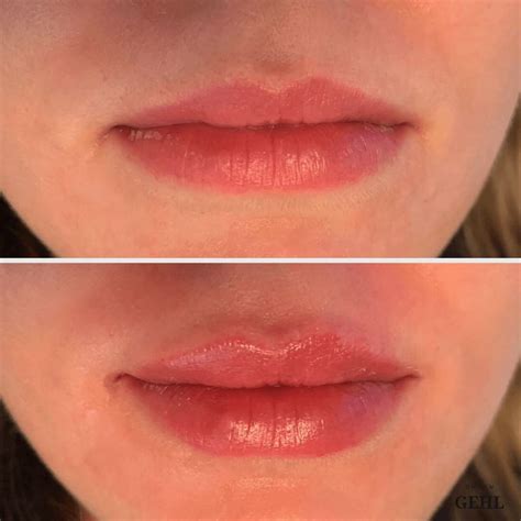 Botox Lip Flip Lippen Ordination Dr Benjamin Gehl