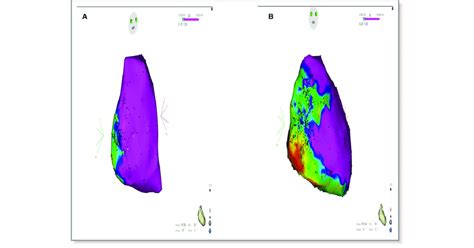 Endocardial A And Epicardial B Electroanatomical Voltage Map In