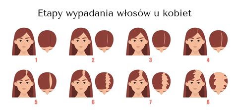 Wypadanie W Os W Przyczyn Nadmiernej Utraty W Os W