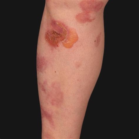 Epidermolysis Bullosa Acquisita