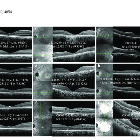 Fundus Abnormalities Observed In Cone And Cone Rod Dystrophy Cod Cord