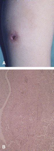 Clear Cell Hidradenoma Journal Of The American Academy Of Dermatology