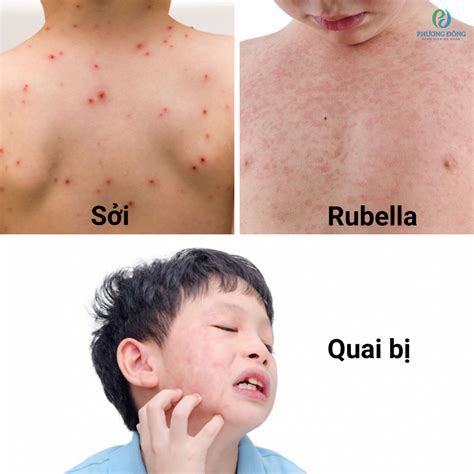 Bệnh Sởi Quai Bị Rubella Triệu Chứng Biến Chứng và Cách Phòng Ngừa