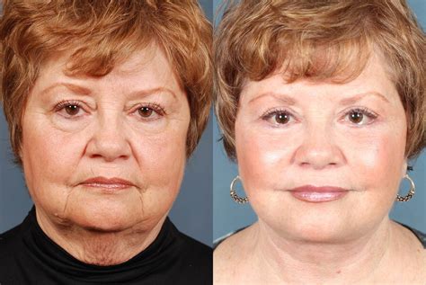 Facelift Before After Photos Patient 242 Louisville Lexington KY