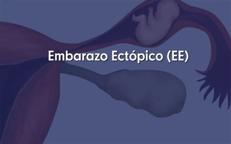 Embarazo ectópico Dr Paez