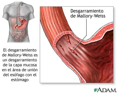 MedlinePlus Enciclopedia Médica Desgarro de Mallory Weiss