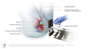 Biopsie De La Prostate Guide Complet Groupe Sant Pourtous