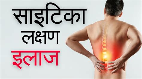 Sciatica Ka Ilaj Sciatica Ke Lakshan Sciatica Treatment In Hindi