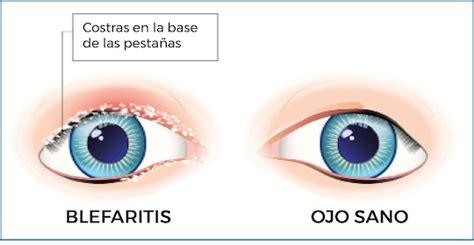 Blefaritis Qu Es Cu Les Son Los S Ntomas Y Qu Tratamiento Existe