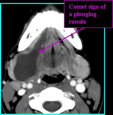 Ranula Rads | Iowa Head and Neck Protocols