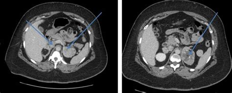 Diagnostic Imaging In Congenital Adrenal Hyperplasia How Does It Help