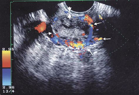 Transvaginal Color Doppler Sonography Showing Surrounding Vessels Case