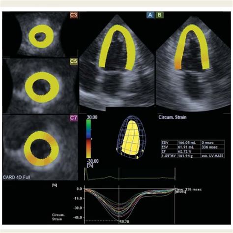 Measurements Of The Left Ventricle Volumes And Function Using