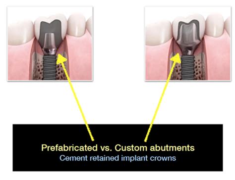 Abutment Selection Flashcards Quizlet