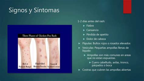 Varicela Zoster Virus Ppt Descarga Gratuita