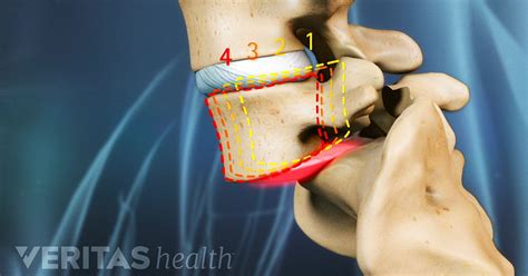 Degenerative Spondylolisthesis