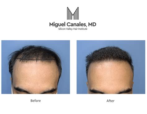 Artas Hair Transplant Mexico Gaye Saucedo