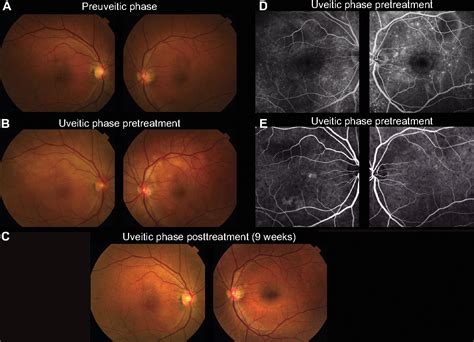 Figure From Clinical Ophthalmology Dovepress Dovepress Clinical