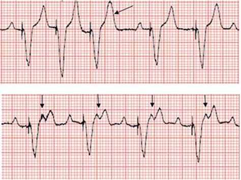 Emergency Medicine Educationecg Pointers Pacemakers