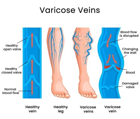 What You Should Do When Youre Bleeding From Varicose Veins Downtown