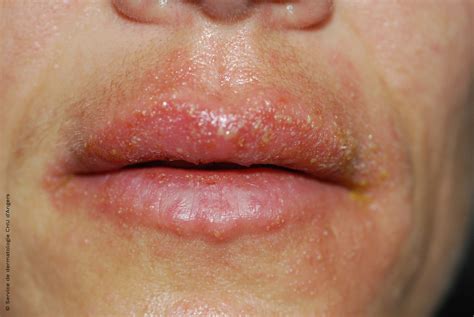 Contact Dermatitis Mouth