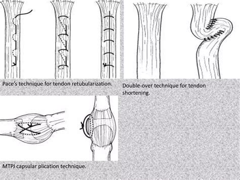 TENDINOPATHY AND TENDON REPAIR..pptx