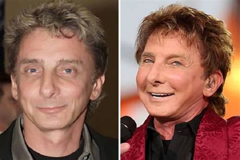 Barry Manilow Before And After Plastic Surgery