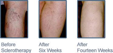 Dermatology Associates Of Southern New Hampshire Leg Vein Treatment