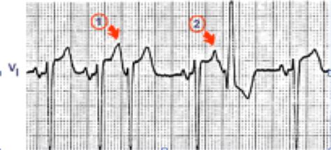 Cardiac Ecg Flashcards Quizlet